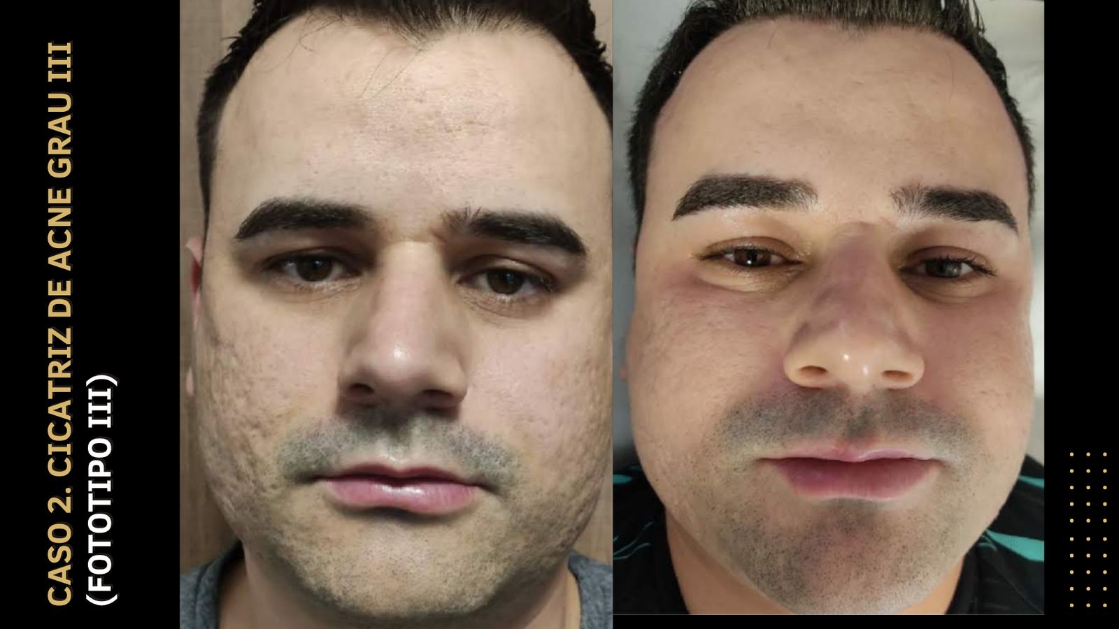 Antes e depois — Cicatriz de acne grau III · Fototipo III