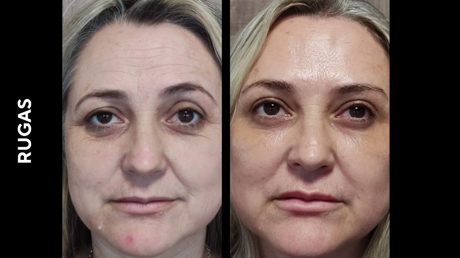 Antes e depois — Rugas faciais