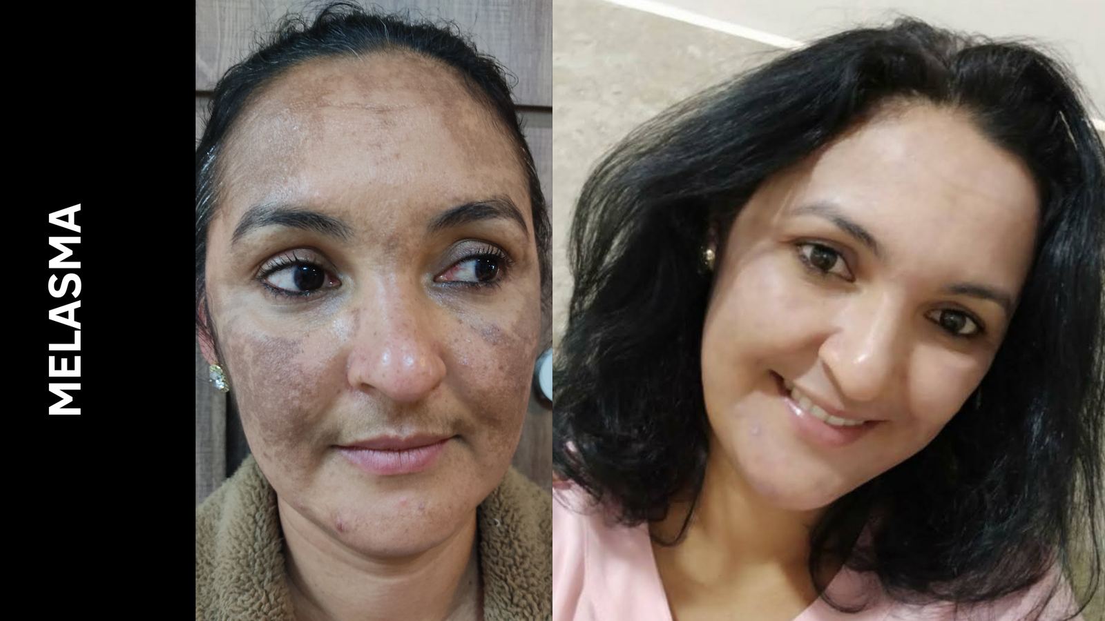 Antes e depois — Melasma