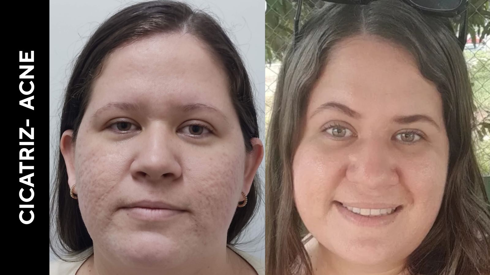 Antes e depois — Cicatriz de acne