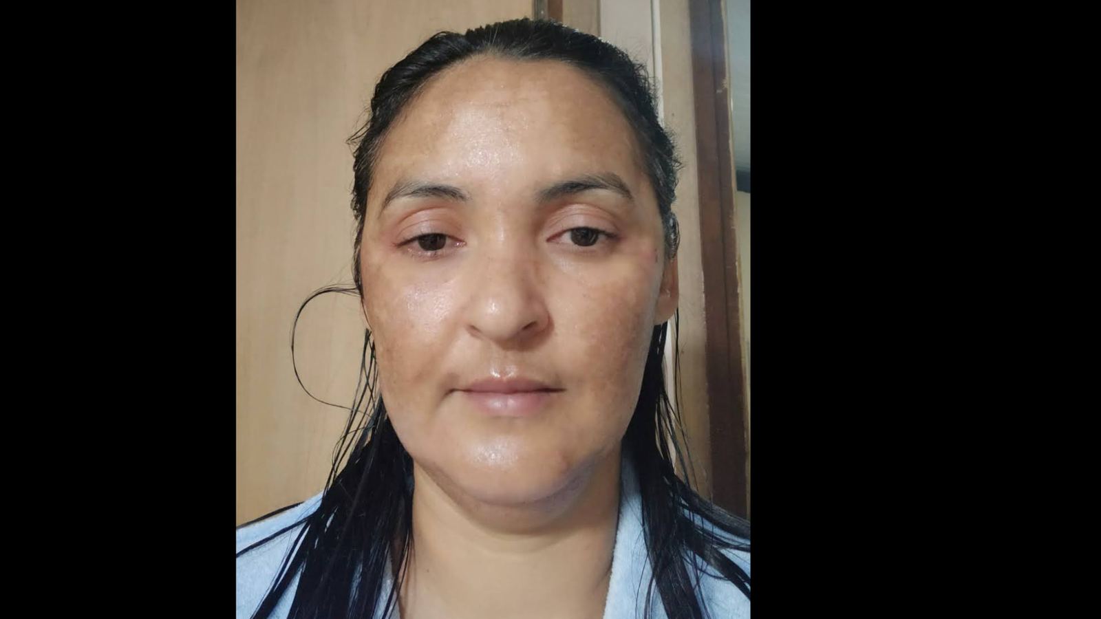 Antes e depois — Melasma