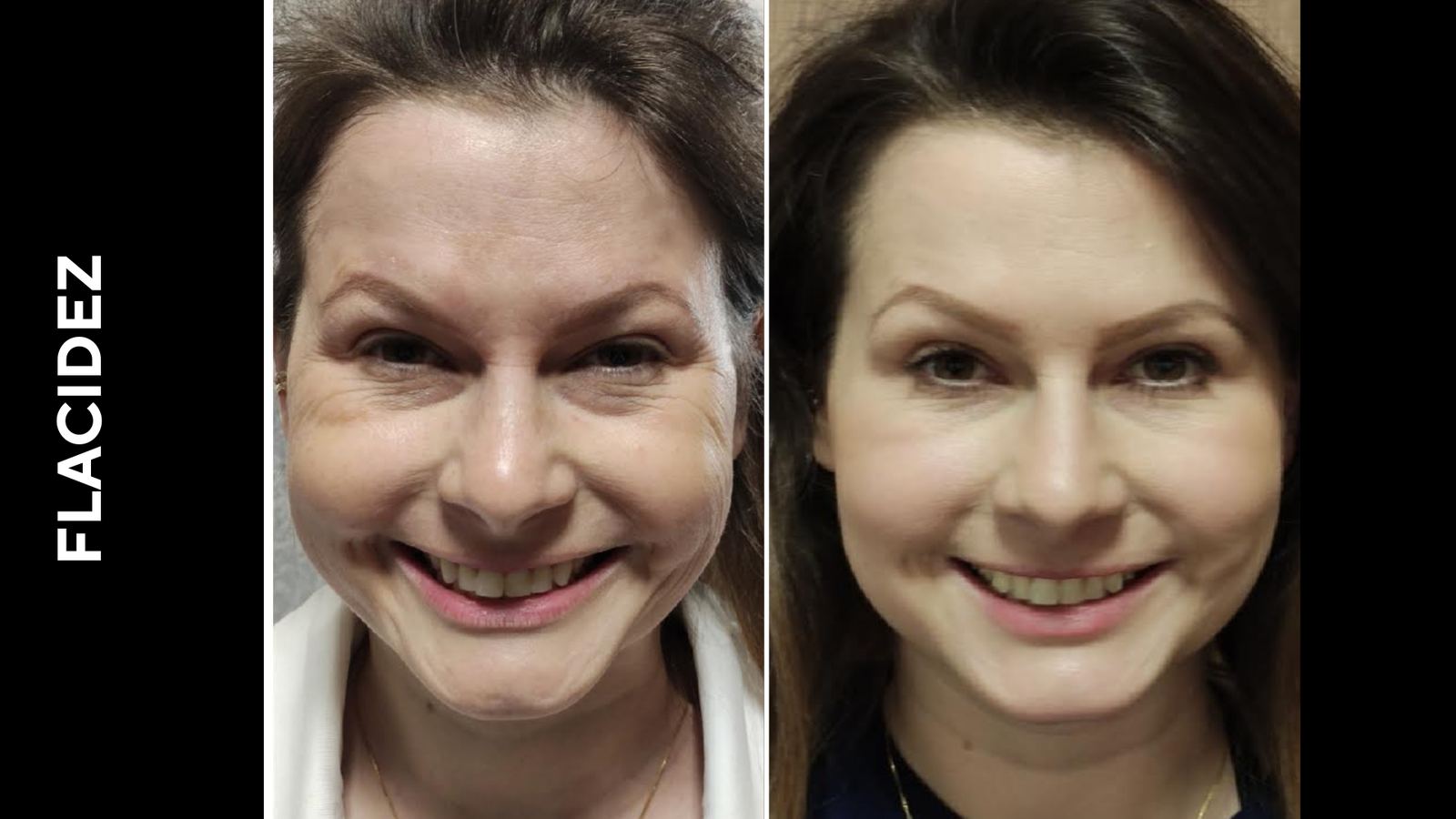 Antes e depois — Flacidez facial