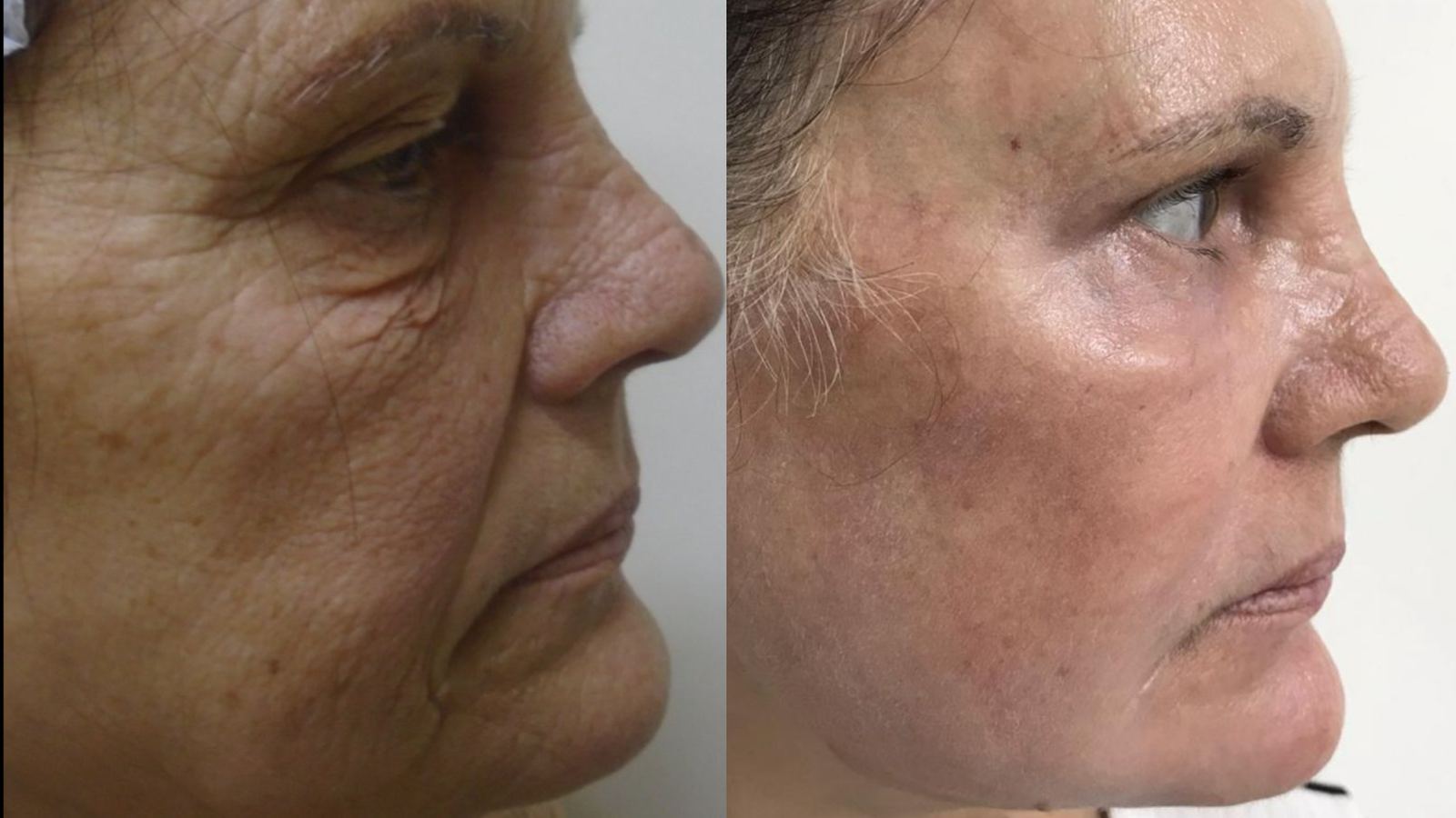 Antes e depois — Rugas, textura e fotoenvelhecimento
