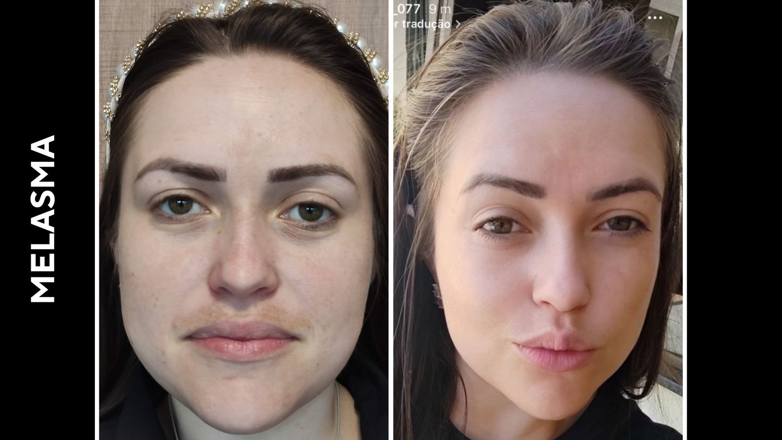 Antes e depois — Melasma