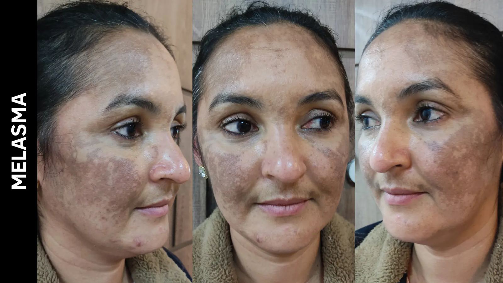 Antes e depois — Melasma