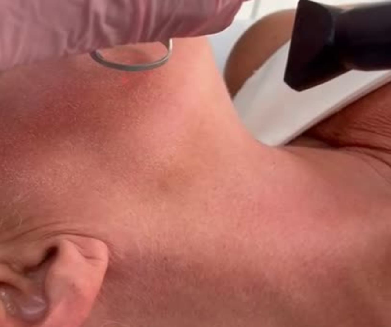 Aplicação de Laser CO2 em face e pescoço, com ponteira fracionada e jato de ar frio