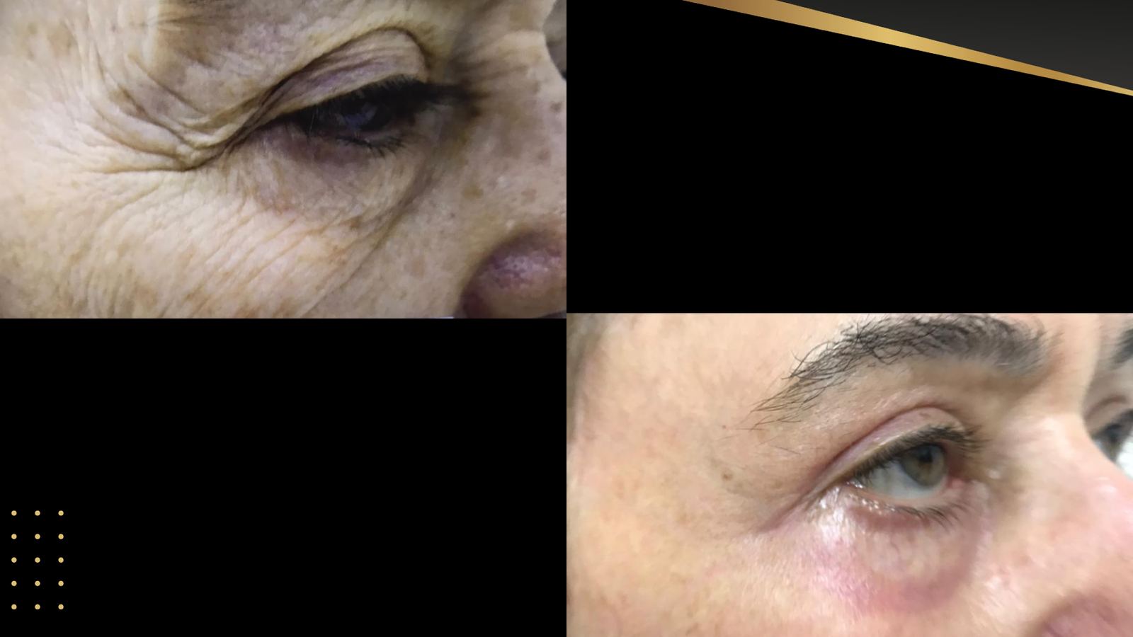Antes e depois — Rugas periorbitais