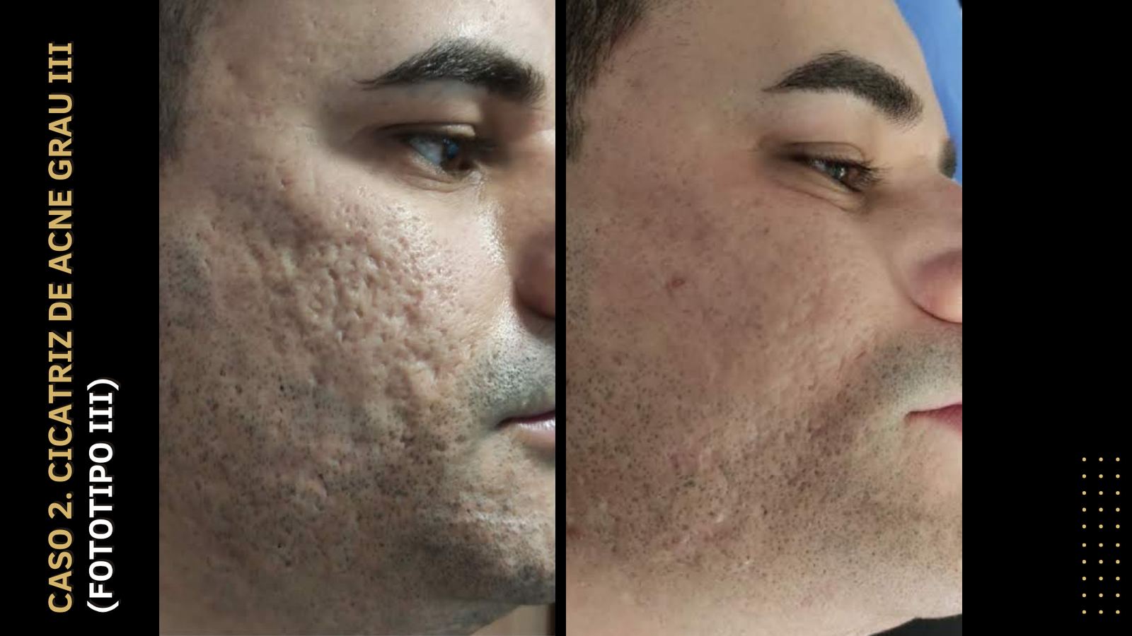 Antes e depois — Cicatriz de acne grau III · Fototipo III