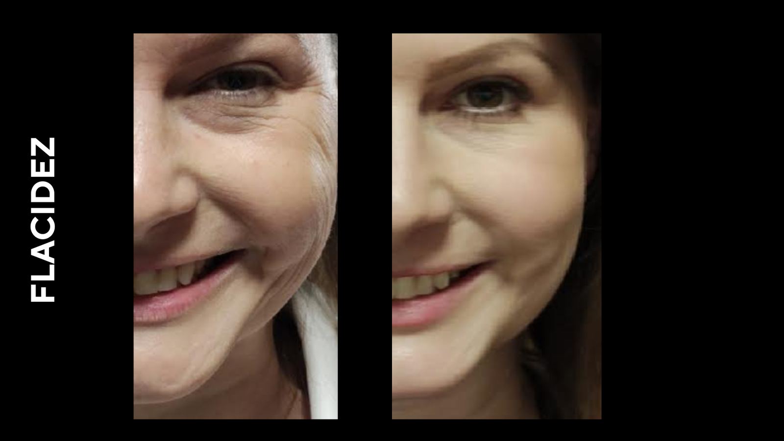 Antes e depois — Flacidez facial