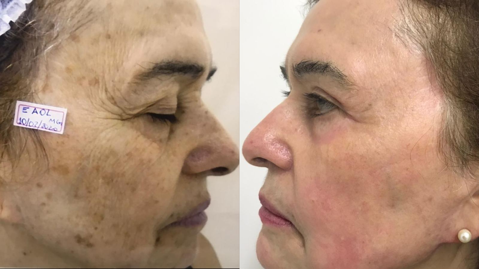 Antes e depois — Manchas solares e qualidade da pele