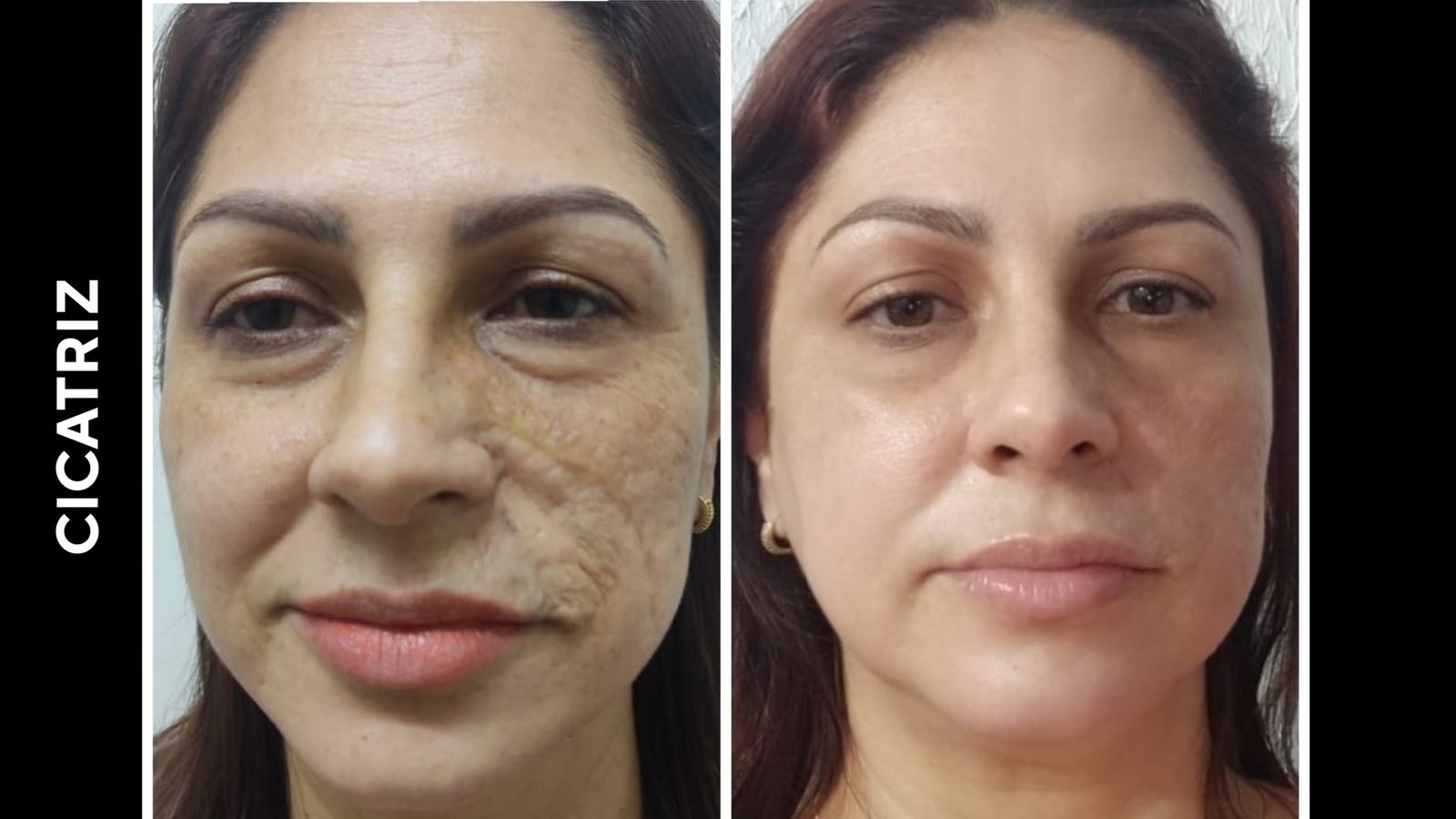 Antes e depois — Cicatriz extensa em face