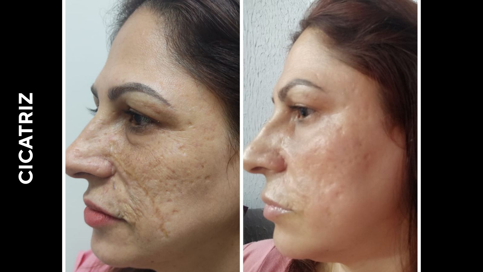 Antes e depois — Cicatriz extensa em face