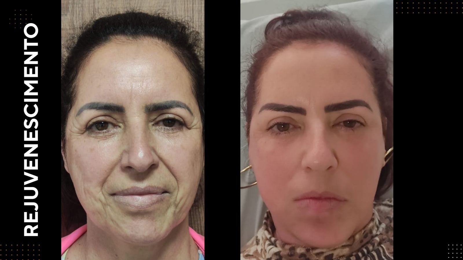 Antes e depois — Rejuvenescimento facial
