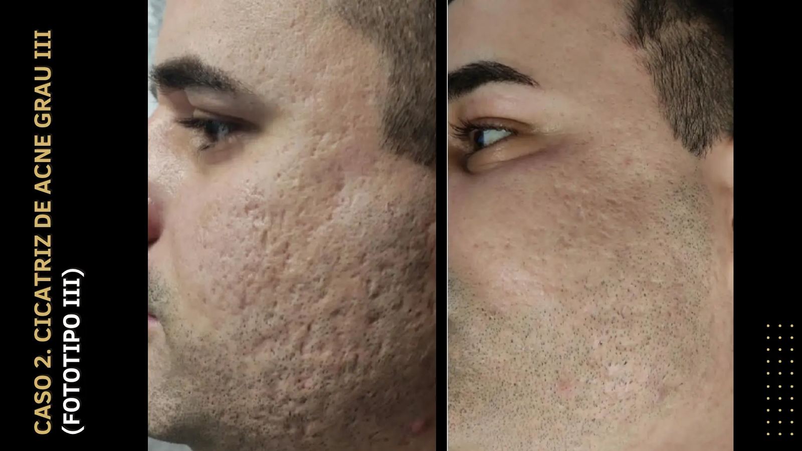 Antes e depois — Cicatriz de acne grau III · Fototipo III