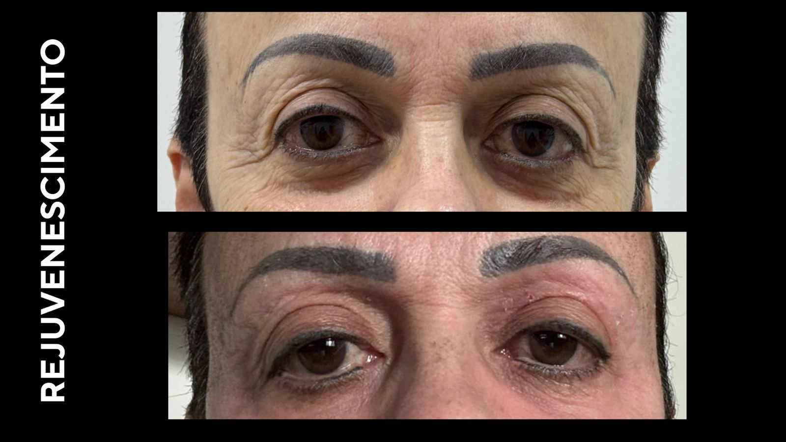 Antes e depois — Rejuvenescimento misto · 70 anos