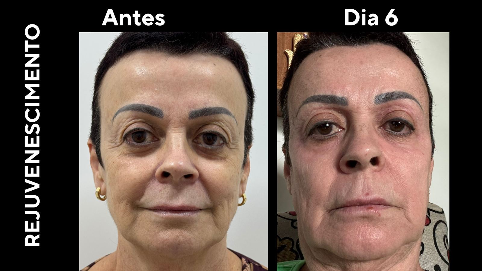 Antes e depois — Rejuvenescimento misto · 70 anos