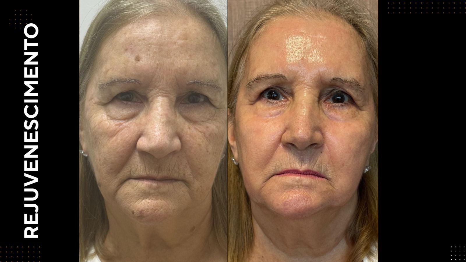 Antes e depois — Rejuvenescimento facial