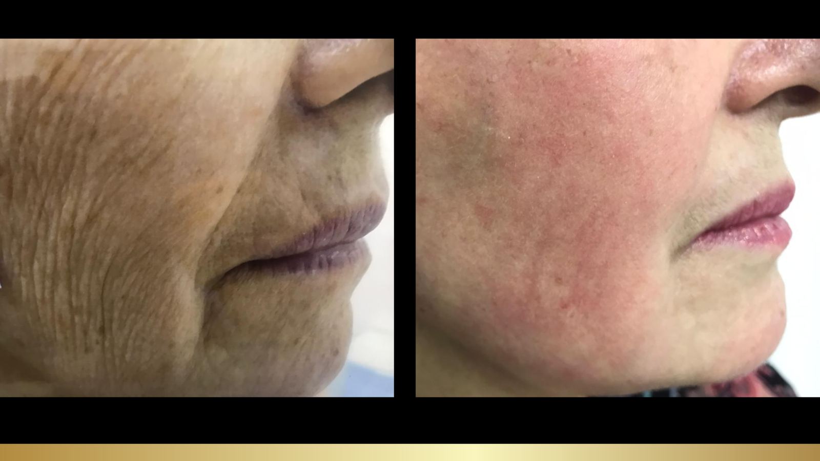 Antes e depois — Rugas periorais e código de barras